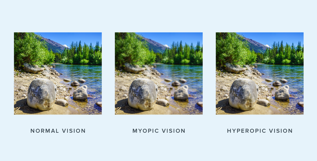 A side-by-side comparison of normal, myopic, and hyperopic vision