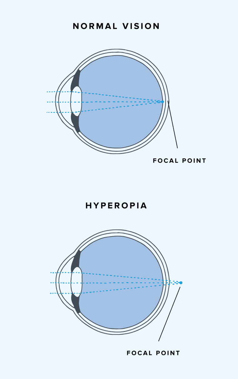 Diagram of how light refracts in a normal eye and one with hyperopia