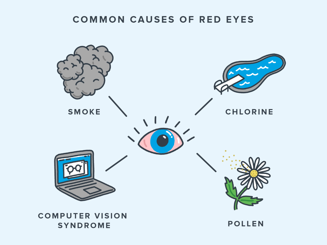 Infographic on red eye causes including smoke, chlorine pools, laptop strain, and pollen allergies.