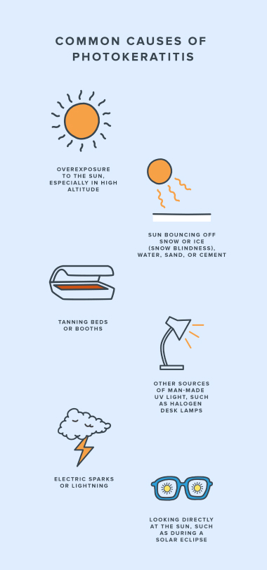 Infographic showing common causes of photokeratitis