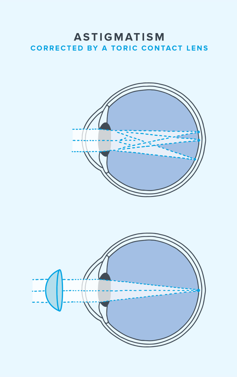 Illustration of astigmatism corrected by a toric contact lens