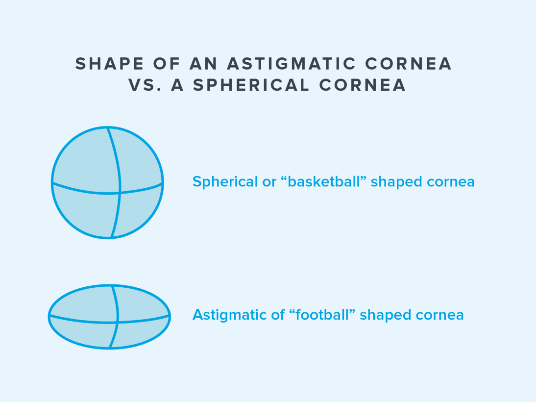 Illustration comparing the shape of an astigmatic cornea with a spherical cornea