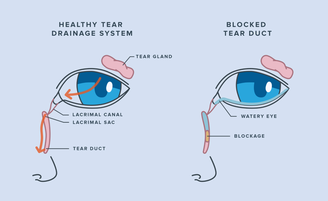 Illustration of an eye with a blocked tear duct