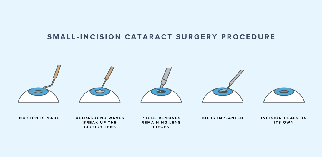 Illustration of the steps for cataract surgery
