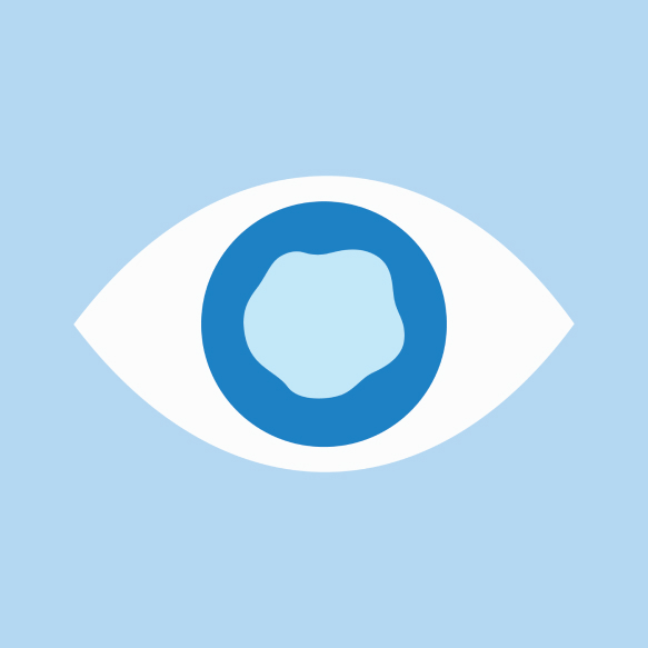 Stylized eye with cataract