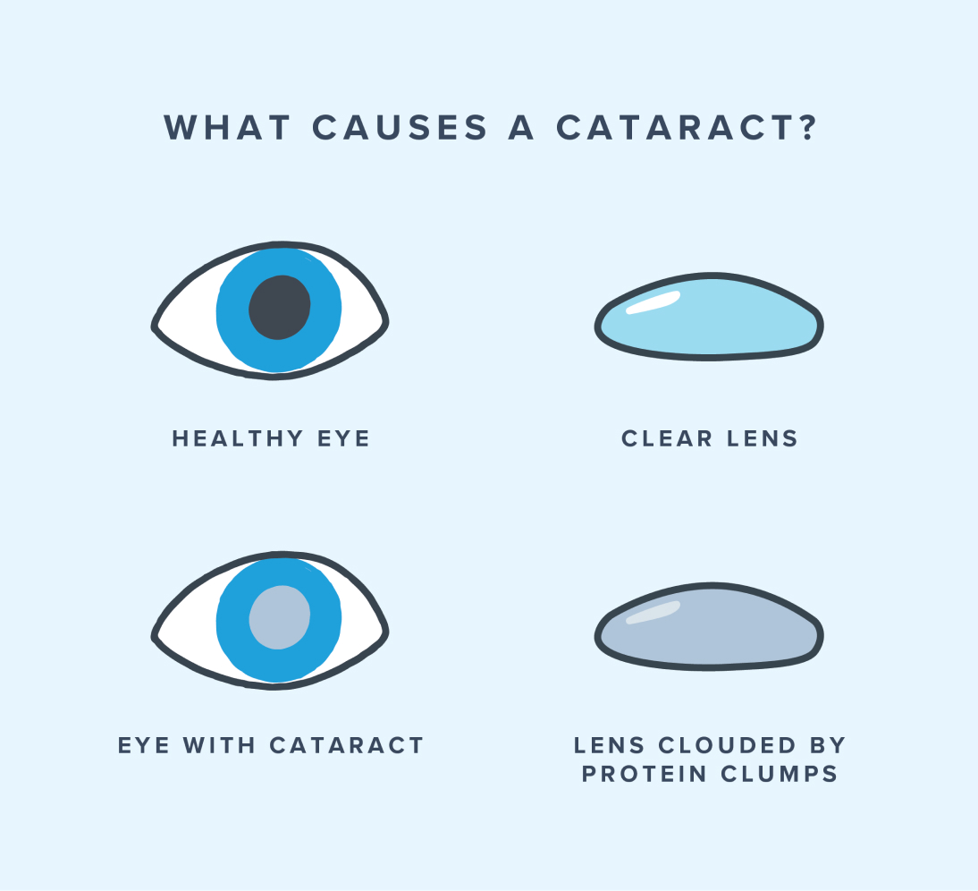 Illustrations of what can cause cataracts
