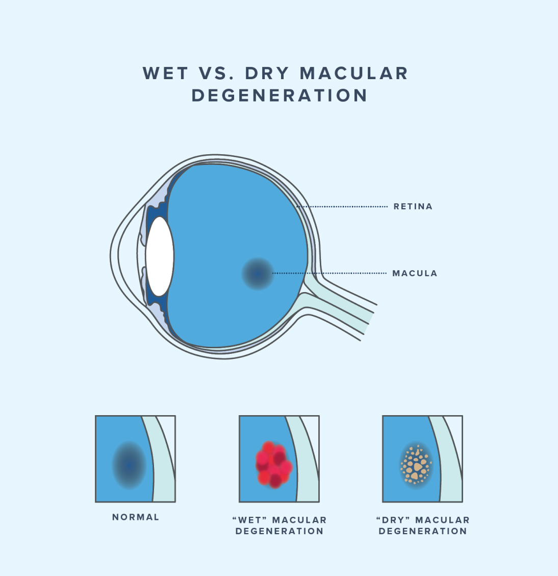 Wet macular degeneration vs dry macular degeneration.