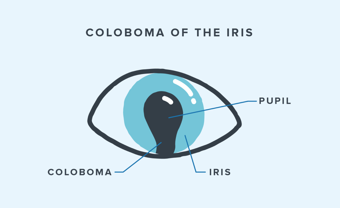 Illustration showing what coloboma of the iris is.