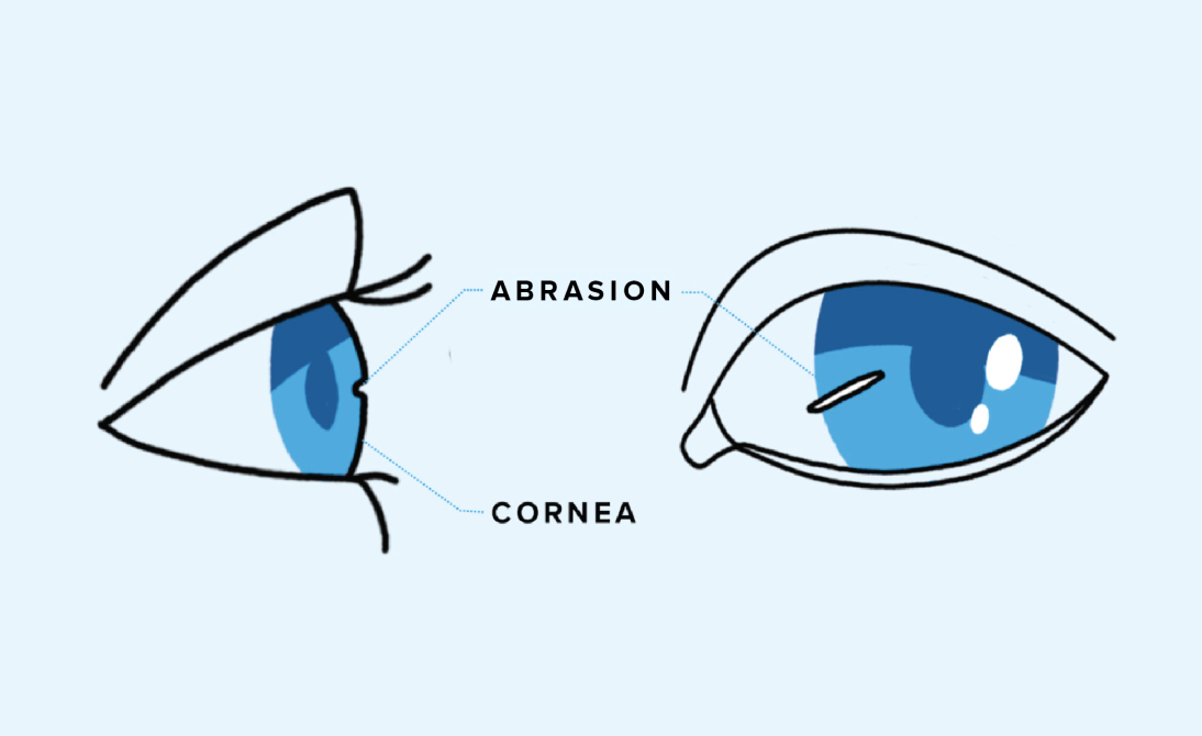 Infographic of an eye abrasion