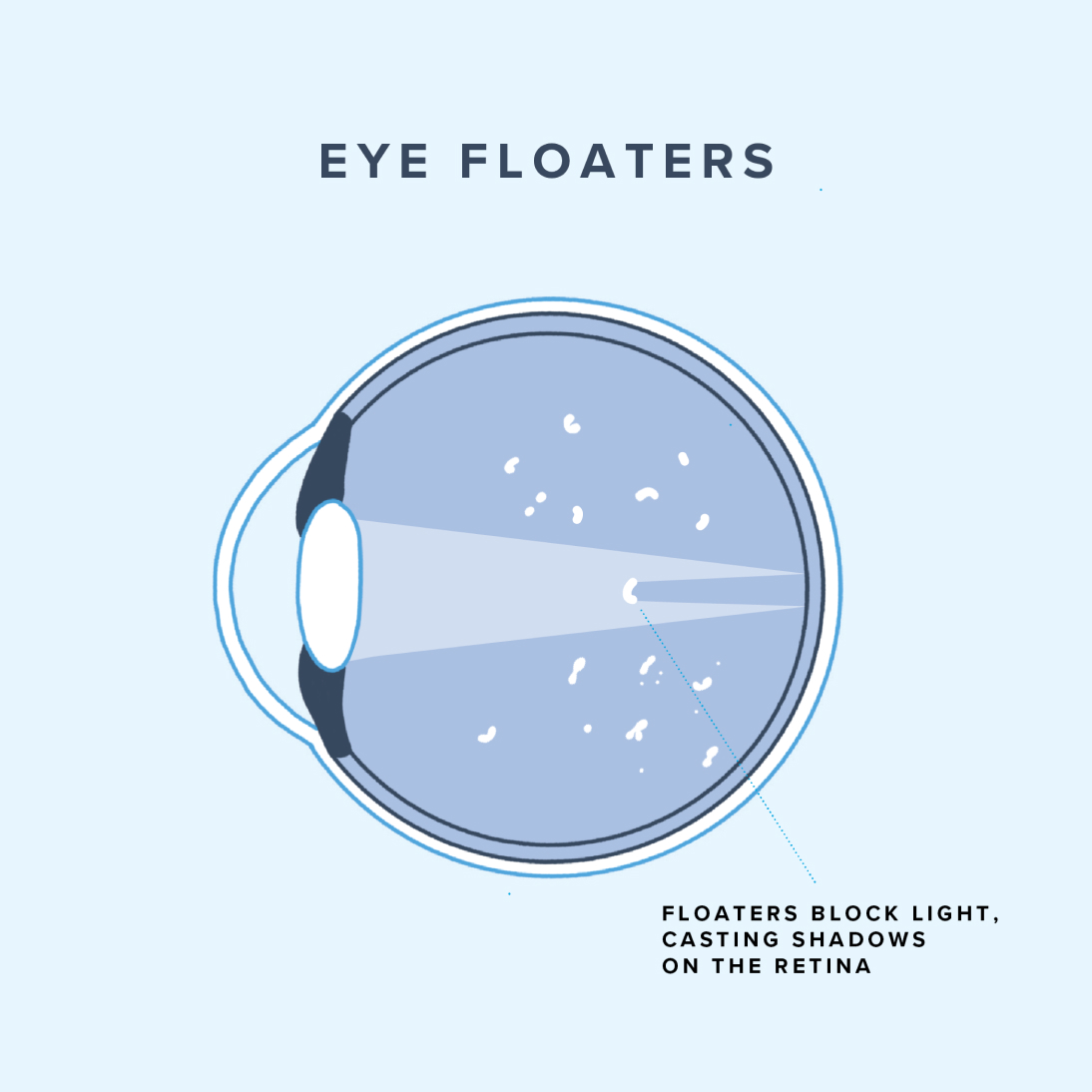 Infographic of eye floaters