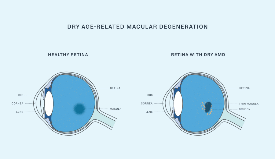 Dry age-related macular degeneration (AMD)