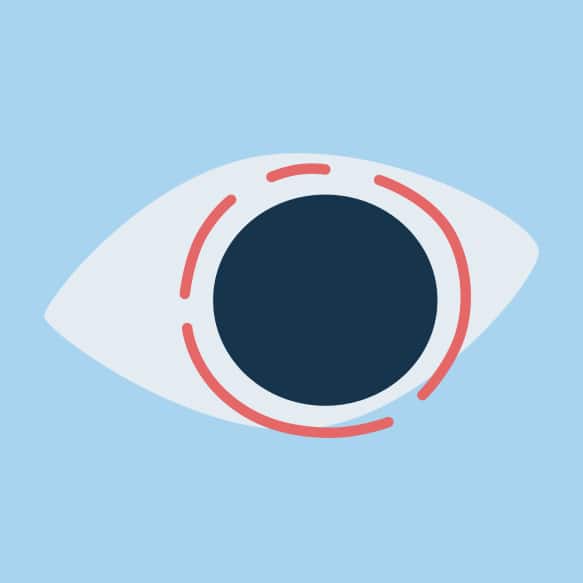 Illustrated eye with surgery lasers