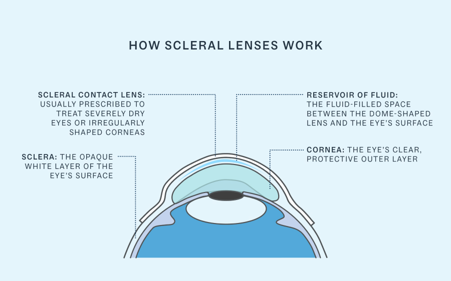 Diagram depicting how scleral lenses work
