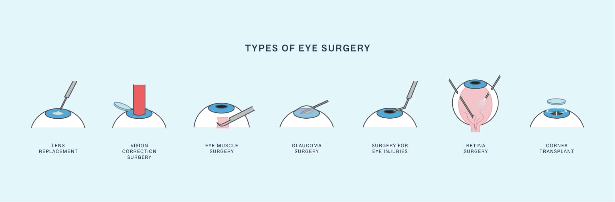 Types of eye surgery