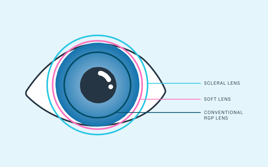 Image depicting different types of contact lenses